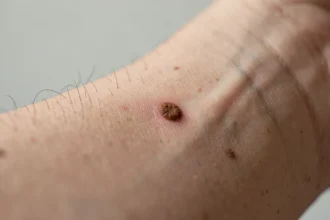 Grain de beauté brun régulier sur la peau d'un avant-bras