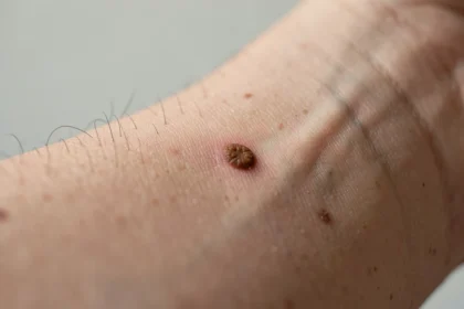 Grain de beauté brun régulier sur la peau d'un avant-bras